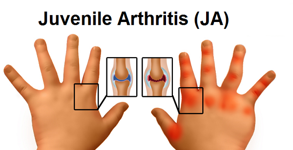 Juvenile arthritis has many types and are diagnosed in many ways. Arthritis needs to be treated by a pediatric rheumatologist.